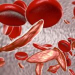 Sickle Cell Anaemia
