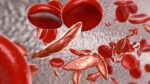Sickle Cell Anaemia